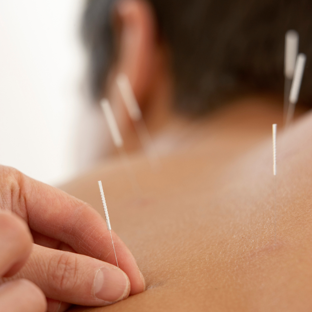 Traditional Acupuncture Healing