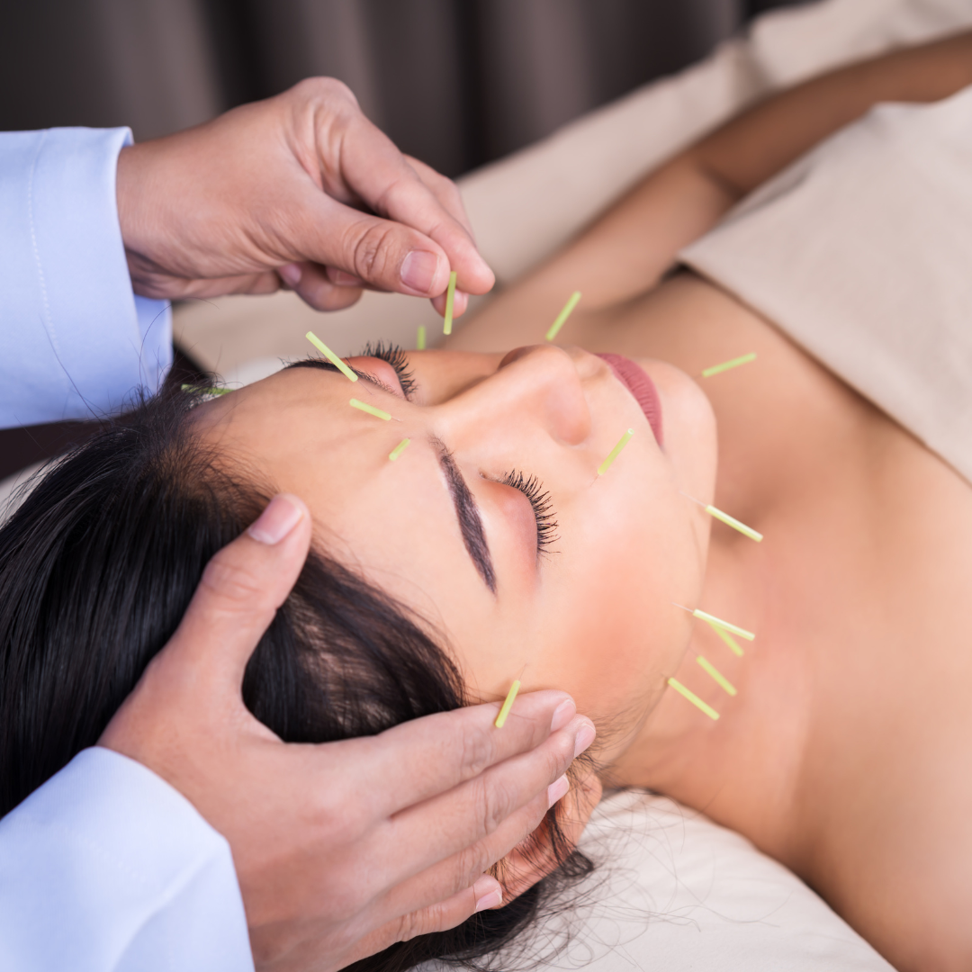 Acupuncture Therapy